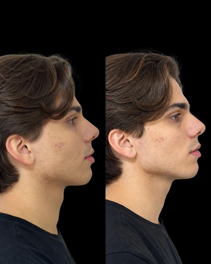 Antes e depois: Contorno mandibular · perfil