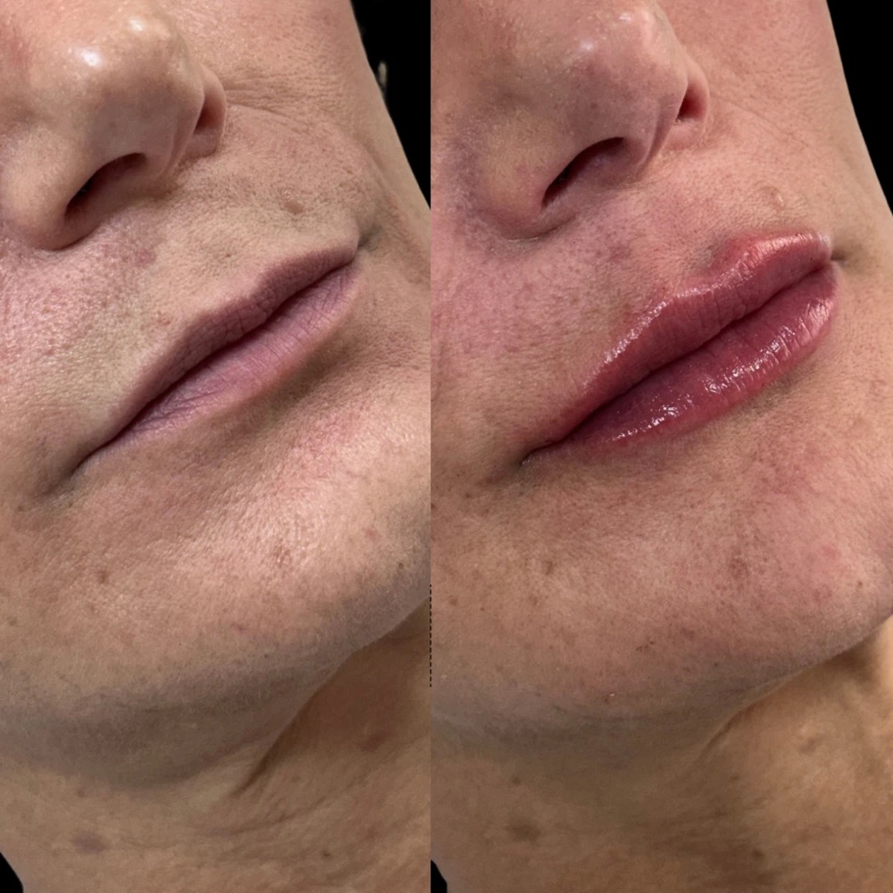 Antes e depois: Lábios