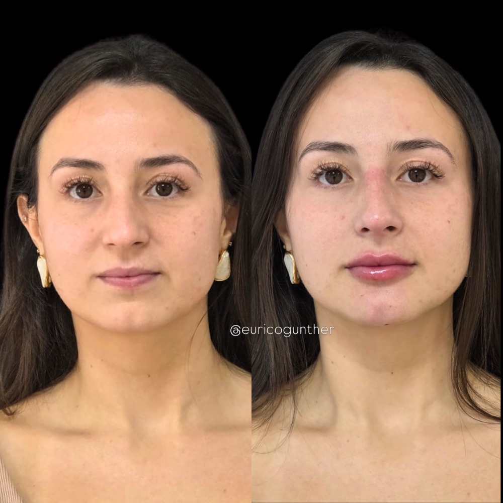 Antes e depois: Harmonização facial